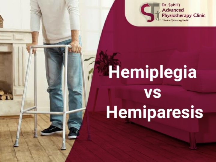 Hemiplegia Hemiplegia vs Hemiparesis