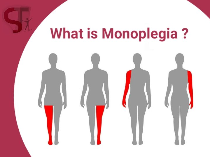 physiotherapy for monoplegia in thane